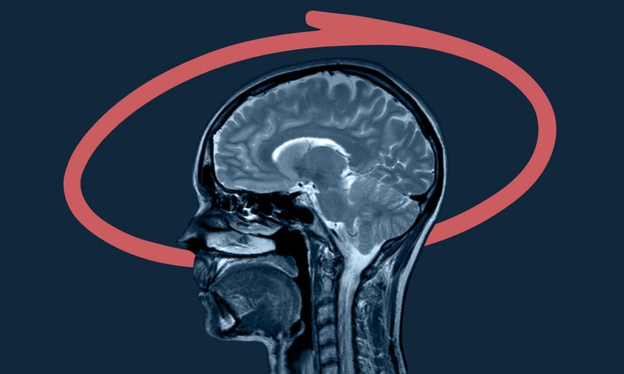 ¿Cómo actúa el Alzheimer contra el cerebro?