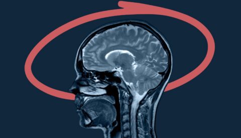 ¿Cómo actúa el Alzheimer contra el cerebro?